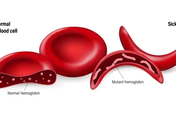 Sickle Cell Disease(SCD): Save the Next African Generation 