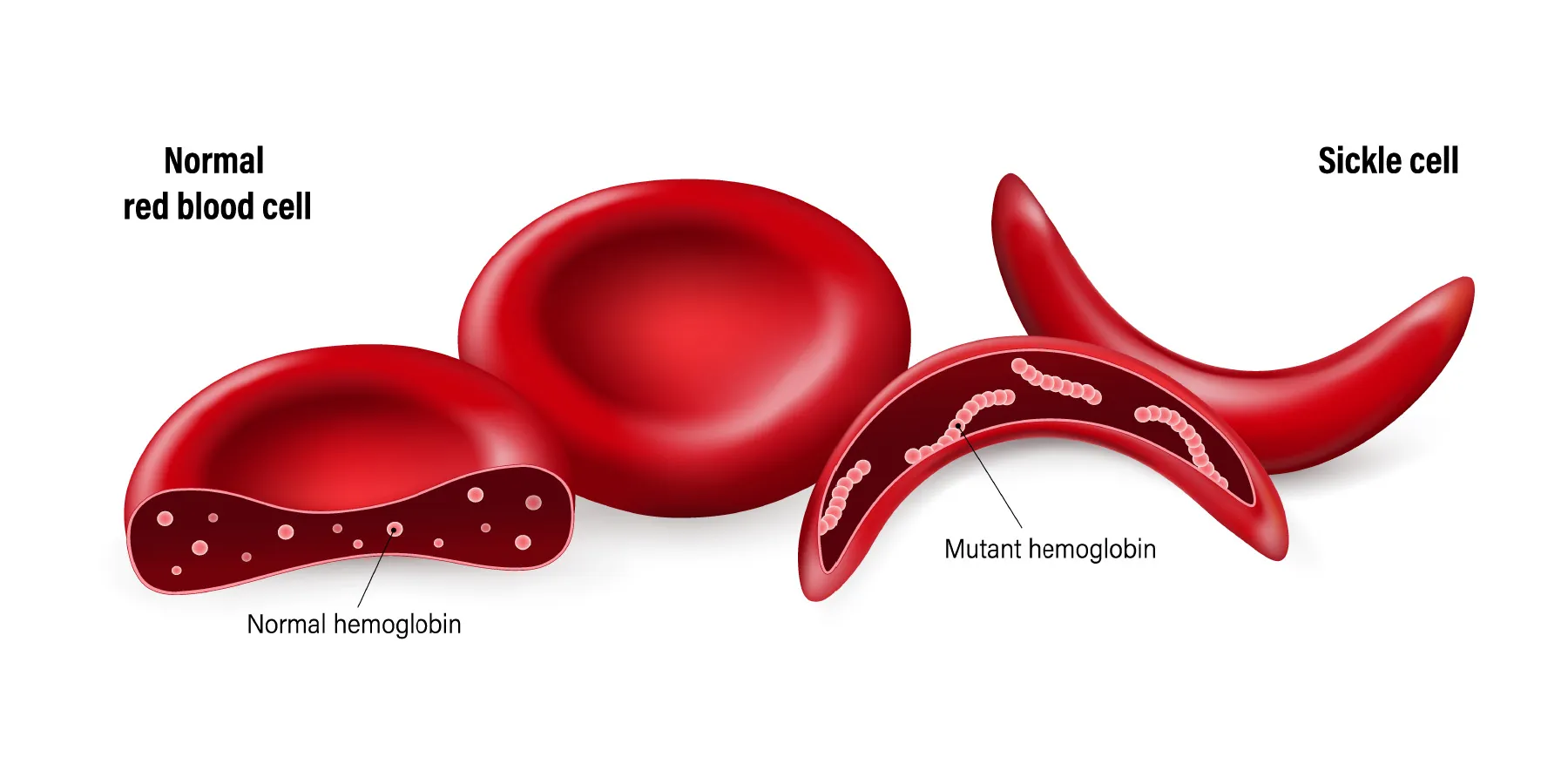 Sickle Cell Disease(SCD): Save the Next African Generation 