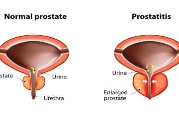 Benign prostrate hypertrophy