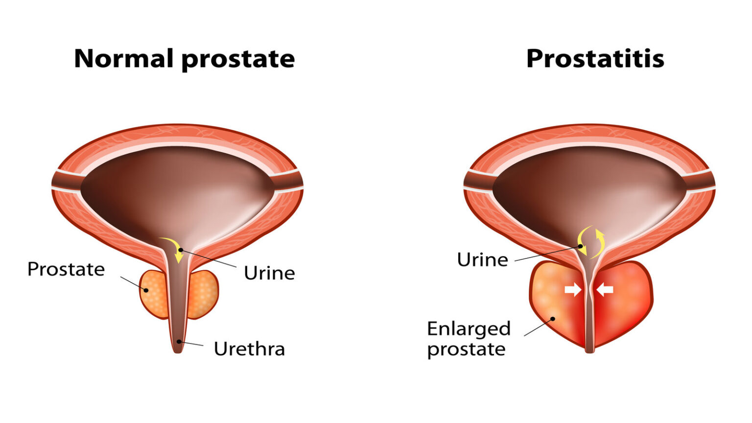 Benign prostrate hypertrophy